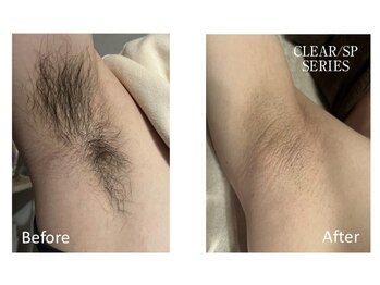 ベルフィオーレ(bel fiore)/メンズ脱毛 脇