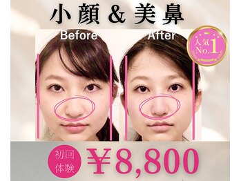 ラプリ 横浜店(Raplit)/隆鼻+輪郭矯正40分10回