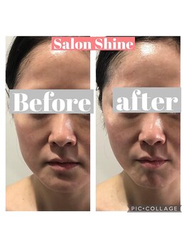 サロンシャイン(Salon Shine)/ＲＥＶＩ半顔体験