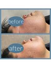 エステ シンセリティー(aesthetic sincerity)/ヒゲ脱毛5回◇毛穴洗浄/シミケア