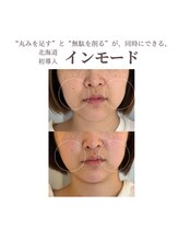 フォルディオ(FORDIO)/インモード[札幌/円山]