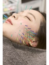 ヴィーライン 大阪梅田院(VeLine)/形状記憶美容鍼