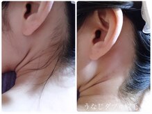 サロン ド モア(salon de MORE)/うなじのダブル脱毛