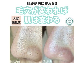 リッカロッカ(RIKKA&ROCCA)/毛穴エクストラクション