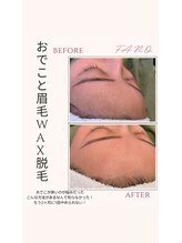 ファーノ/狭いおでこが光り輝くおでこに