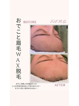 ファーノ/狭いおでこが光り輝くおでこに