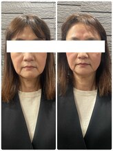 長寿鍼灸院 長寿整骨院/美容鍼50本の効果★小顔効果