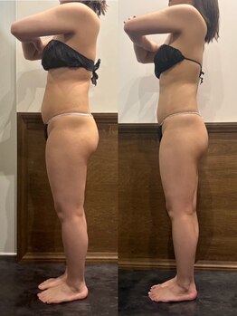 パリスヒロトン(PARIS HIROTON)/痩身20代の方の症例