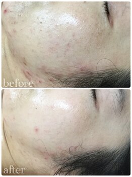 メイユール(MEILLEUR)/光フェイシャル6回