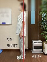 たか施術院/頭痛 肩こり 20代学生 3回目