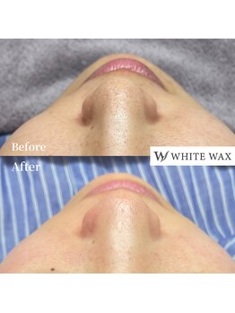ホワイトワックス 浜松(WHITE WAX)/60分で素肌が変わる◎