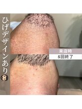 アカラビューティー(Akala Beauty)/おひげデザインできます！