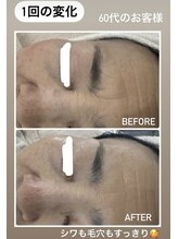 エスプラス エヌプラス(S+/N+)/フェイシャルエステ　ビフォアフ