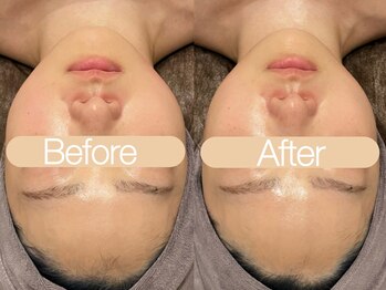 クレヴィア バイ サイバーエステ(CREBIA)/【小顔コルギ】即効性あり☆