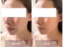 アファン 鶴見店(Afun)/小顔BeforeAfter