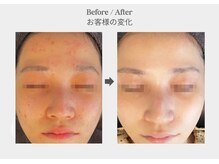 ベル 新橋(Belle)/ハーブピーリング×ニキビケア