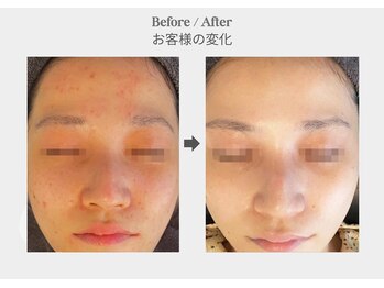 ベル 新橋(Belle)/ハーブピーリング×ニキビケア