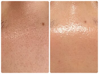 コア(Coeur)/ポツポツとした毛穴にも◎