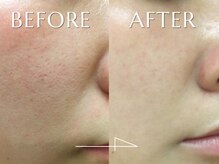 神門 メディカルラボ MEILI院(MedicalLab)/20代 | 女性 | ハーブピーリング