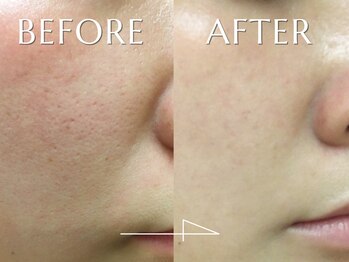 神門 メディカルラボ MEILI院(MedicalLab)/20代 | 女性 | ハーブピーリング