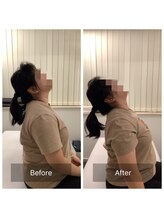 ナオル整体 新宿院(NAORU整体)/20代女性-猫背矯正Before/After