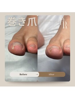 パズルリングネイル(Puzzle.ring Nail)/巻き爪施術