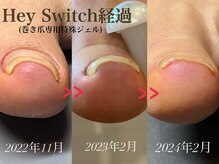 ルアナネイル(Luana Nail)の雰囲気（大人気『巻き爪緩和ジェル～HeySwitch～』１度の施術で緩和◎）
