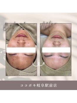 ココポキ 岐阜店の写真/【毛穴の開き、黒ずみ、肌のくすみにお悩みの方へ◎】お肌のお悩みを改善し、透明感のあるツヤ美肌へ♪