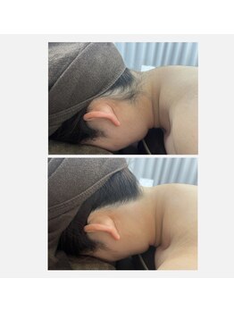 ミース 仙台長町店/うなじ矯正●ビフォーアフター