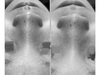 リグレム バイ フェローズ(Riglem by fellows)/大人気★ハイドロトリートメント