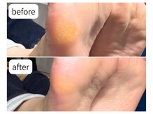 カシェット(Cachette)/40代女性◎足裏角質ケア90分