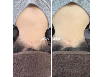 サロン ヴィラ(villa)/#うなじ脱毛#脱毛