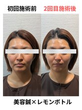 ケンビ(Kenbi)/美容鍼×レモンボトル《吉野町》