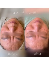 &still【アンドスティル】【4/1 NEW OPEN（予定）】 /【ホワイトスノーピール】：1回