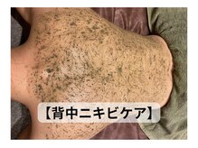 ブレアドール(Blair-Doll)/背中のニキビサヨナラ★