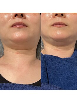 bou 新宿/顎下のお肉も一回で!!