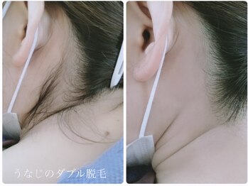 サロン ド モア(salon de MORE)/うなじのダブル脱毛