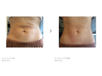 Nビューティー/最新RFサーモシェイプオーパス