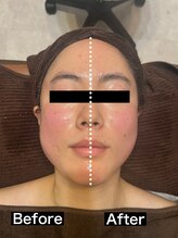 ハーズプラス(hers+)/小顔コース