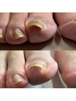 巻き爪矯正3回目（右親指）