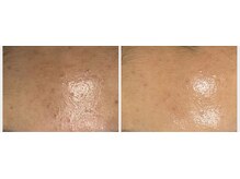 ミュー 新小岩店(Mieux)/セラピール5回効果