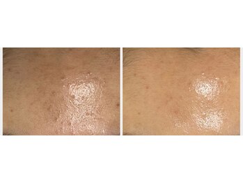 ミュー 新小岩店(Mieux)/セラピール5回効果