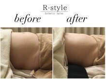 エステサロン アールスタイル(R-style)/テスラスカルプトビフォア写真