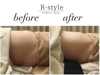 エステサロン アールスタイル(R-style)/テスラスカルプトビフォア写真