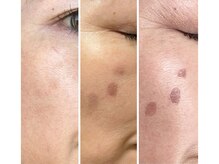 向かって左から、施術前→施術直後→4日目と変化していきます。