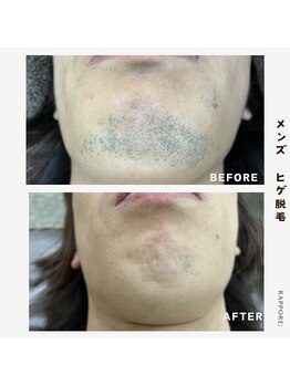 ラポール(rappore;)/ひげ脱毛