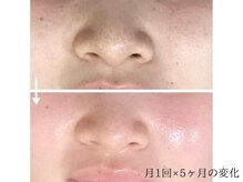 こもれびの雰囲気（継続ケアで毛穴が詰まりにくい素肌へ☆吸引なしでもこの変化）