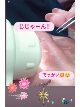 グラジュス(grazus)/毛穴