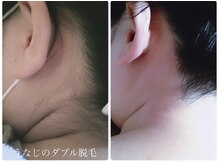サロン ド モア(salon de MORE)/うなじのダブル脱毛