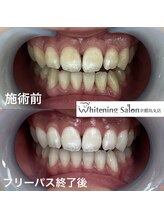 ホワイトニングサロン 京都烏丸店/ホワイトニング施術例